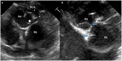 Case Report: Challenging Perioperative Decision-Making in a Neonate With Transposition of Great Arteries and Novel Coronary Anatomy